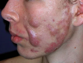 acne-face_2_29