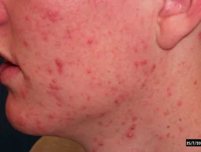 acne in het gezicht