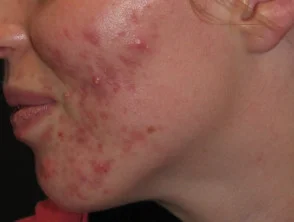 acne-face_2_32