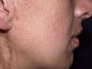 acne in het gezicht