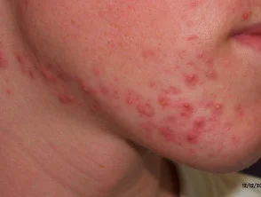 acne in het gezicht