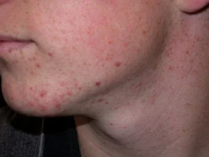 acne-face_2_7