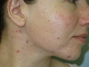 acne in het gezicht