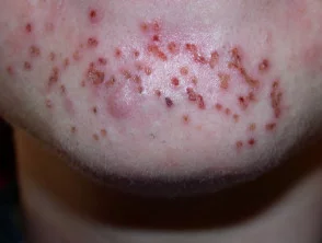 acne in het gezicht