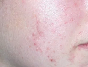 acne in het gezicht