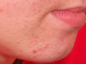 acne in het gezicht