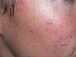 acne in het gezicht