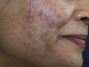 acne in het gezicht