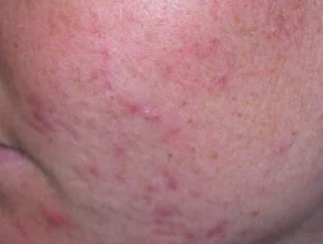 acne in het gezicht