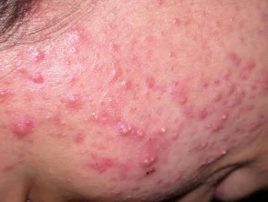 acne in het gezicht