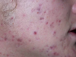 acne in het gezicht