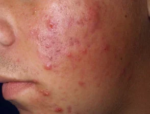 acne in het gezicht