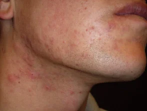 acne-face_3_12