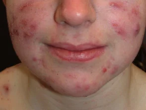 acne-face_3_21