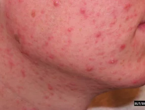 acne in het gezicht