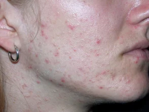 acne-face_3_3