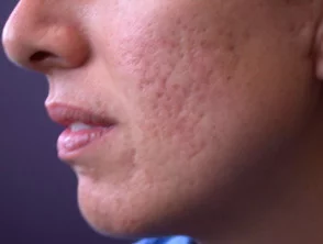 acne in het gezicht