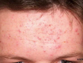 acne in het gezicht