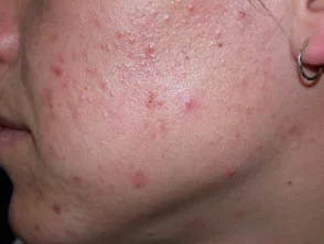 acne in het gezicht