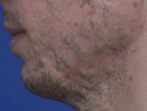 acne in het gezicht