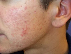 acne in het gezicht