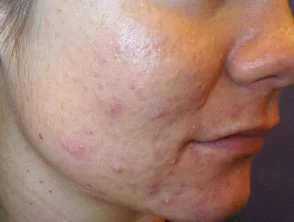 acne in het gezicht