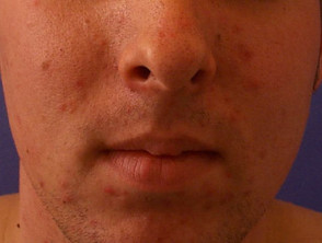 acne-face_34