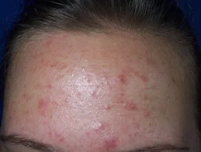 acne in het gezicht