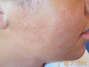 acne in het gezicht