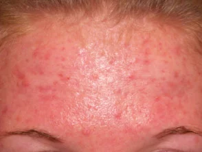 acne in het gezicht