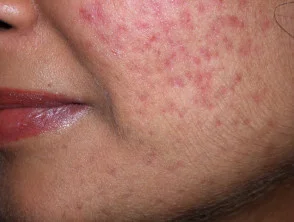 acne in het gezicht