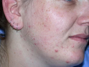 acne in het gezicht