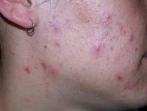 acne in het gezicht