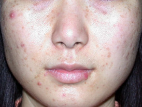 acne-face_43