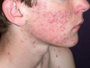 acne-face_47