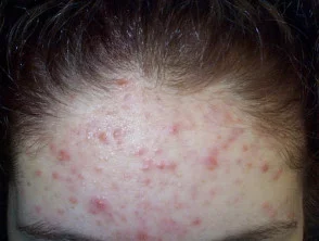 acne in het gezicht