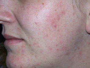 acne in het gezicht