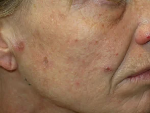 acne in het gezicht