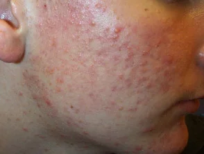 acne-face_5_6