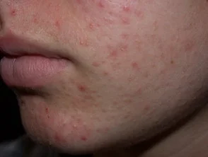 acne in het gezicht