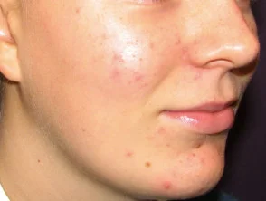 acne-face_6_4