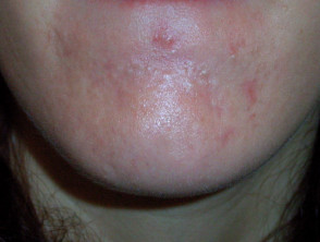 acne-face_63