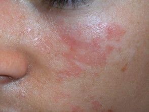 acne-face_64