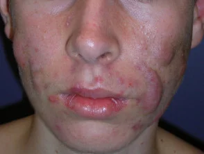 acne-face_69