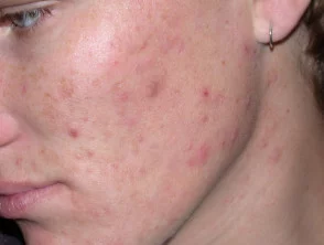 acne in het gezicht