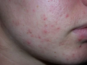 acne in het gezicht