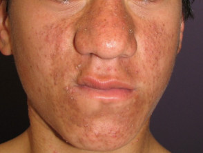 acne-face_71