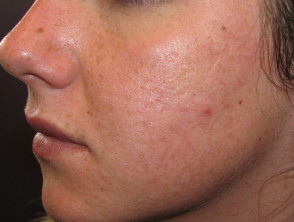 acne-face_78