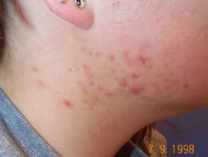 acne in het gezicht