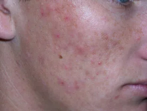 acne in het gezicht